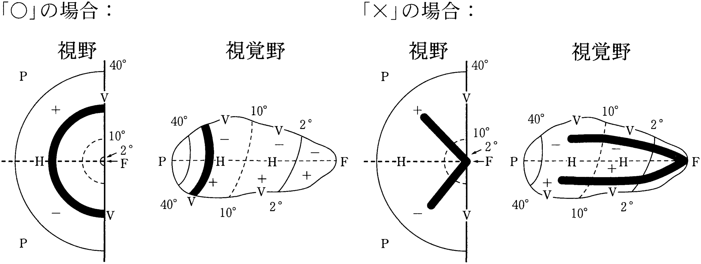 図3—4　視野の左側に見える視覚対象(「○」と「×」)と対応する大脳右半球の視覚野の領域(ともに黒の太線で示す)